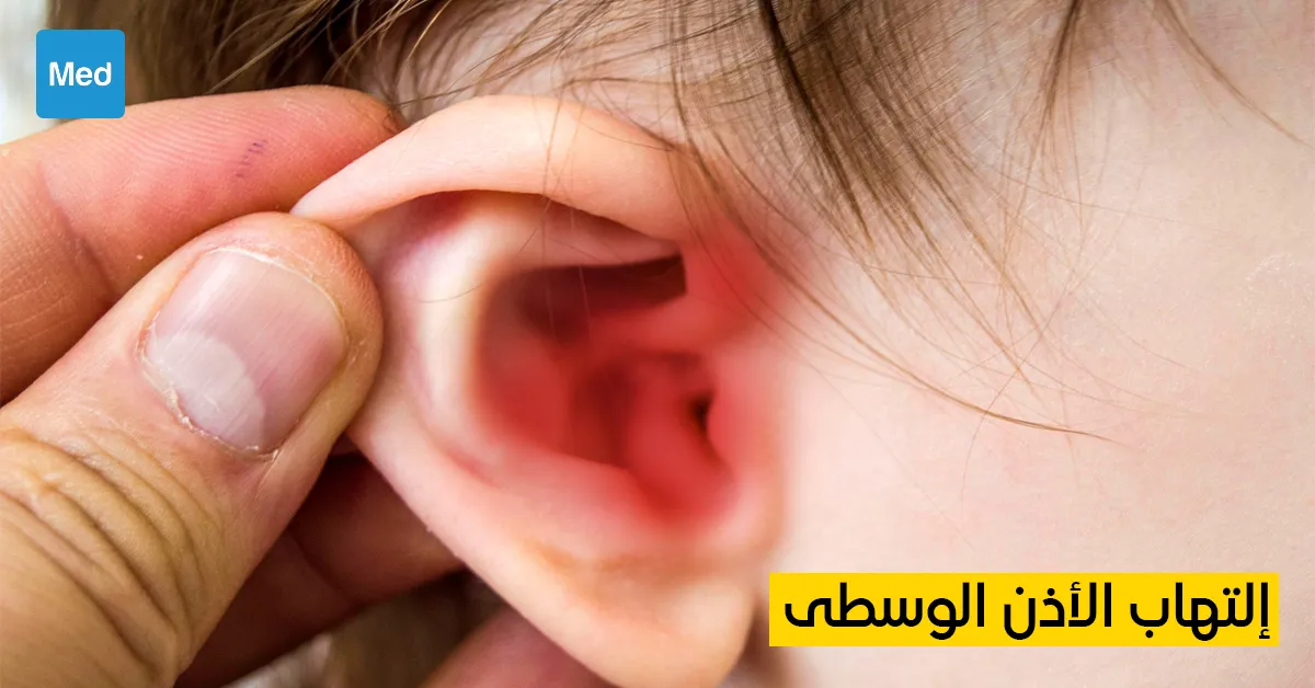 التهاب الأذن الوسطى